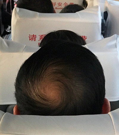 别瞧不起秃顶,稀疏的毛发里有星系