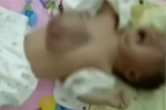 女婴心脏裸露体外怦怦乱跳 医生手术塞回胸腔
