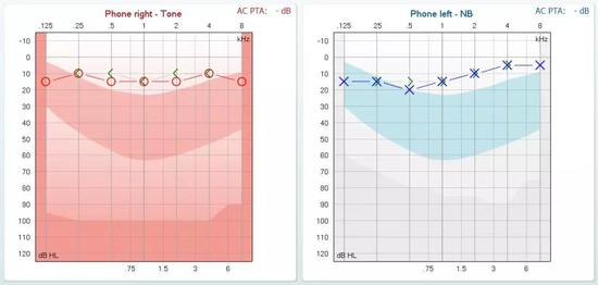 △小晨做的纯音听阈测定，显示双耳纯音听阈正常范围。
