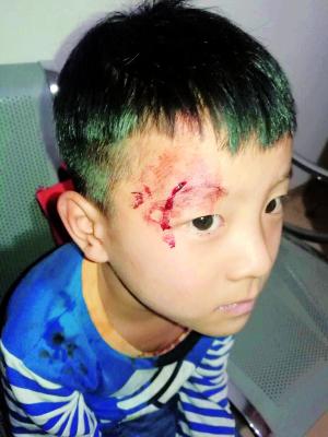 
													 　　男童面部右铡眉弓外受伤流血。　　家属供图
												