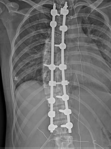 中山14岁女孩脊柱侧弯 医生用3D打印手术让她长高5cm_新浪广东_新浪网