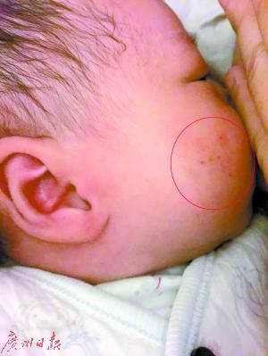 5月2日小娴出院时，小脸蛋儿上有湿疹样东西及红痕。