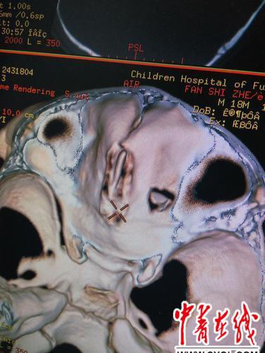 孩子眼眶及脑补CT图片