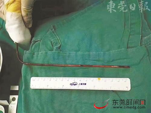 钢条贯穿男童头部，让人触目惊心市儿童医院供图