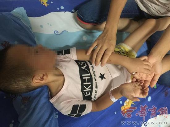 来舅舅家过暑假的甘肃庆阳3岁男童在咸阳一小区广场玩耍时不慎被电线绊倒，双手被电击烧伤，目前仍在治疗。
