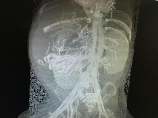 影像检查显示，垚垚腹腔主要脏器的位置长反了。