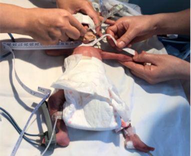 汕头超早产3胞胎“手掌宝宝”出院 出生不足两斤