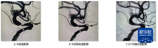 广东省中医“介入无植入”技术为脑血管狭窄提供策略