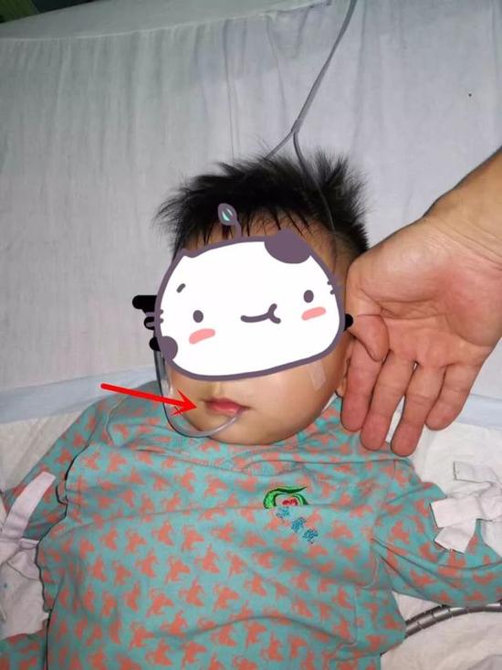 (治疗后:嘴唇颜色恢复)