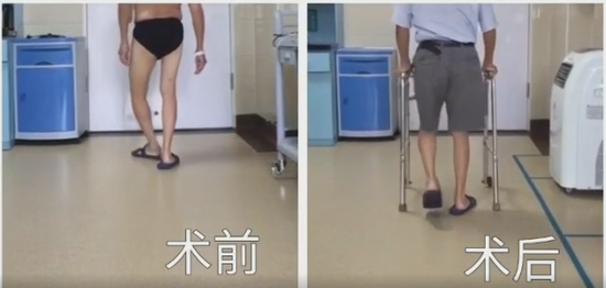 患者术前(左)及术后一个月(右)行走姿势对比