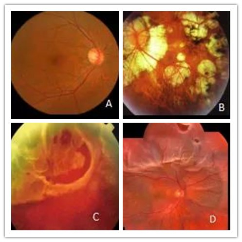 A 正常眼底图片；B 高度近视眼底图片；C 视网膜裂孔；D 视网膜裂孔及视网膜脱离