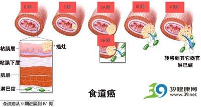 为适应强酸产生恶性变化,进而出现食道癌前病变