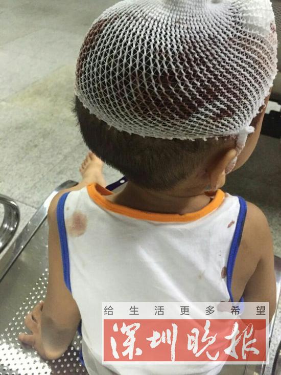 （林阿姨三岁的孙子被玻璃砸伤，头部缝了 6 针。）