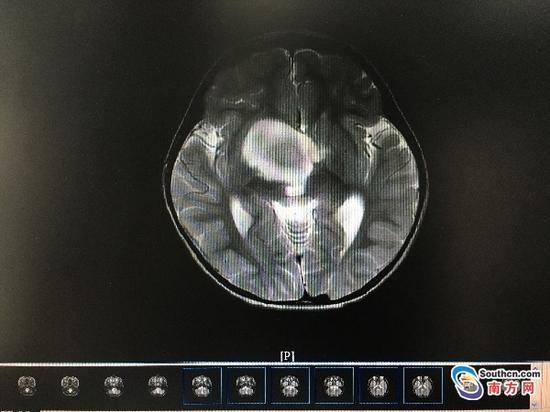 壮壮术前的头部核磁共振图像，中间鸡蛋大小的白影就是肿瘤