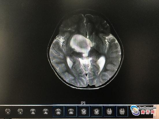 壮壮术前的头部核磁共振图像,中间鸡蛋大小的