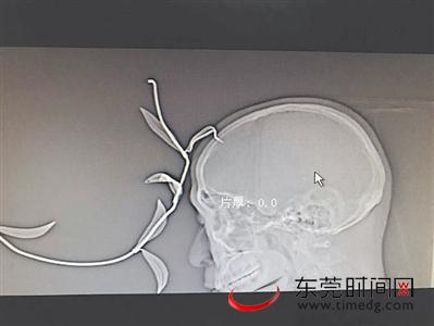 X光片显示，男子被树叶状的金属片扎进头部