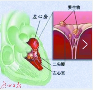 患者的心内膜炎示意图