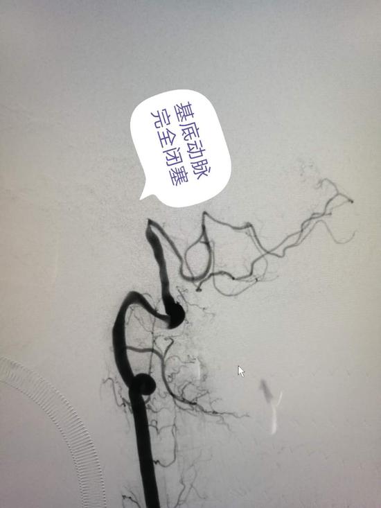 广州中医药大学顺德医院脑病科神经介入再显神