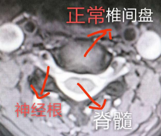 正常的节段神经、脊髓行走通畅
