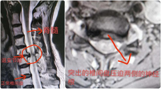 颈椎磁共振中病变节段,椎间盘突出并神经受压