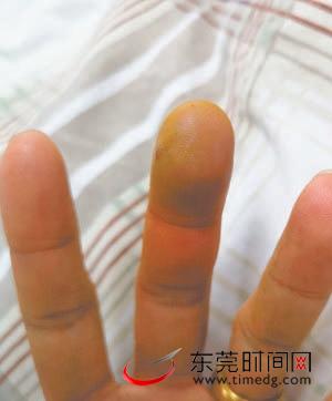 吴先生被鱼刺伤后,当晚手指头发黑很痛,凌晨到医院就诊 市卫计局供图