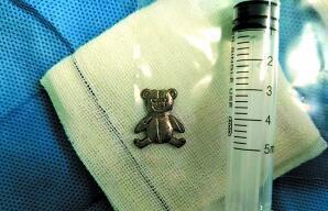 6岁男童老是流鼻涕 原来是因为鼻腔藏了两颗小