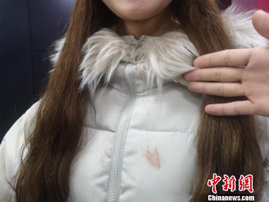 林敏的同学谢某在阻拦轻生者时嘴巴磕破流血,衣服上留着血迹。 朱柳融 摄