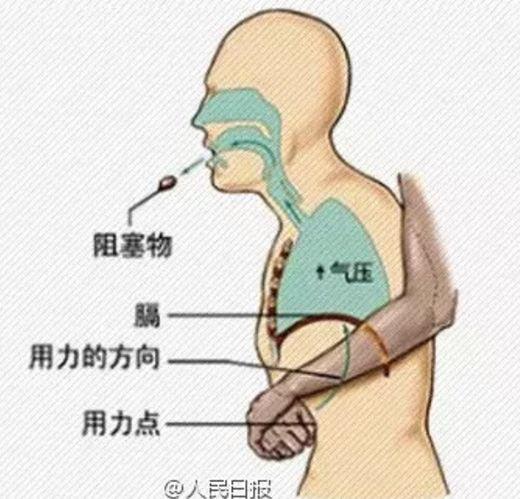 海姆立克急救法示意图