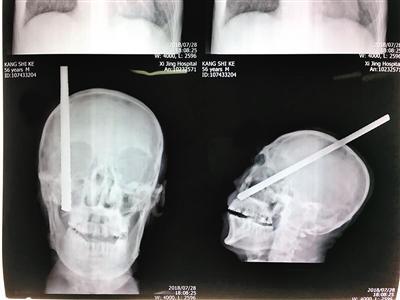 钢筋刺入患者头部的影像 (医院供图)