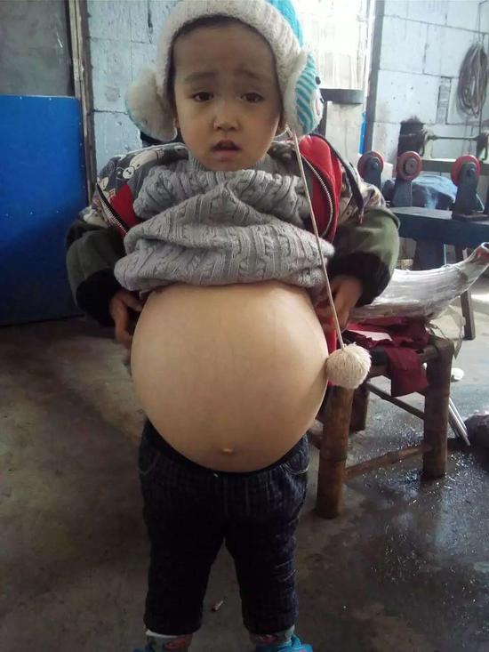 6岁男孩肚子大过皮球 南宁市八医院免费为其治疗(图)