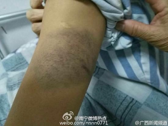 什么情况下需要打肚皮针 kngo-fxwvpar8325094.jpg
