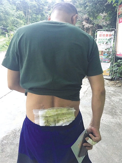 黎先生被打至腰部软组织挫伤