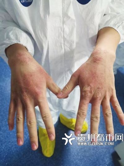 “不是因为特别坚强,而是一份职责担当!”遵医附院这位双手过敏的男护士石小刚,一直没有出隔离病房。