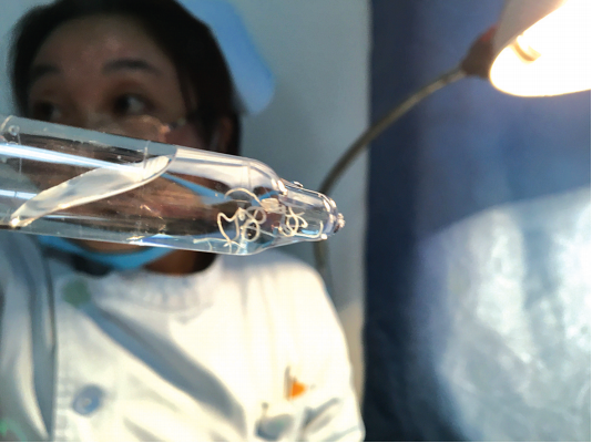 一七旬老人眼睛痒 去医院眼中取出十多条活的