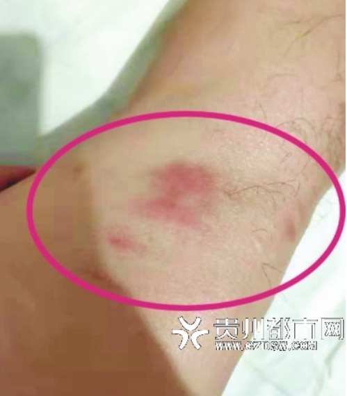 杨先生受伤部位。