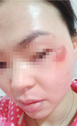 吴女士眼下出现了疤痕,愈合之后出现增生。吴女士供图