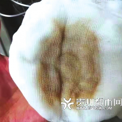 住户们用纱布滤水,纱布被染黄