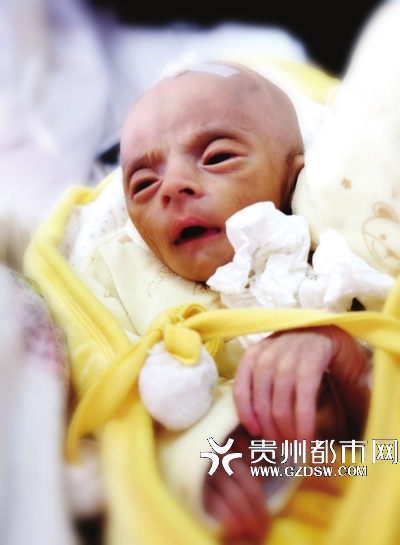 "外星人"宝宝,何止让人泪流满面_新浪贵州_新浪网