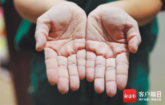  8月7日，在海口市龙塘镇新民村核酸采样点，海南医学院第二附属医院一名医护人员双手被汗水浸泡发皱。 李天平 摄