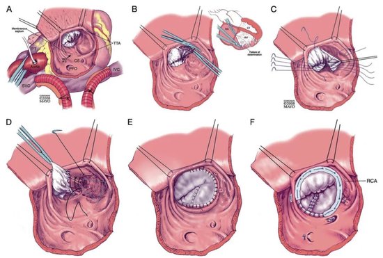 海南省人民医院心脏外科完成一例胸腔镜“Cone”手术，解剖矫治先天性“Ebstein”畸形
