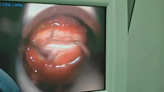 通道显微镜下借助双极电凝准确识别终丝并予以切断