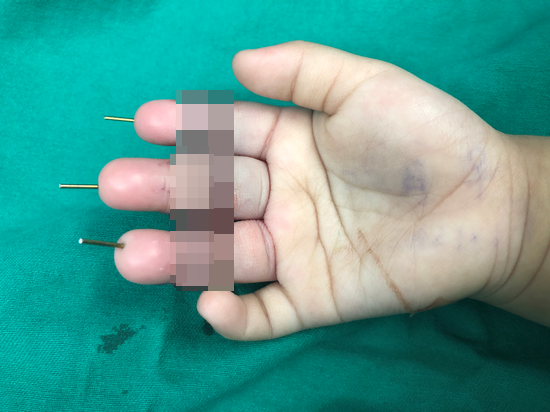 最温暖的“手”护人！海医二院成功为1岁多女童实施三指离断再植手术