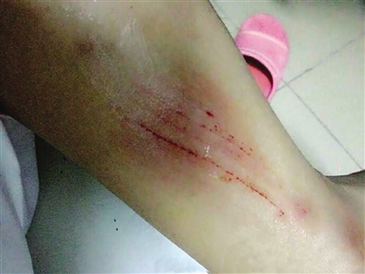 学生腿部受伤(图片来源：网友微博)