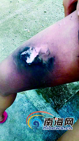 小赵右大腿内侧被烧伤。