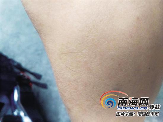 海口外卖小哥被狗咬伤 狗主人:它扑上去是想跟