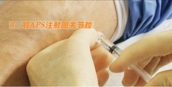 得了关节炎只能“换膝”？骨科专家：乐城引进的自体蛋白疗法带来新选择