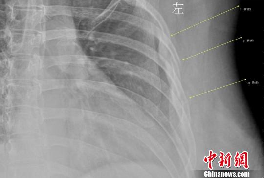 年轻女白领因咳嗽导致三根肋骨骨折 刘姗姗 摄