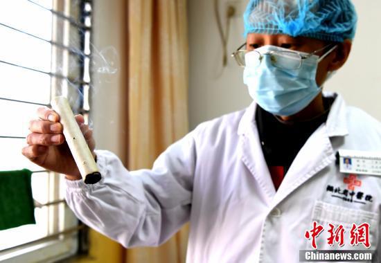 医生展示即将用于患者治疗的艾灸。