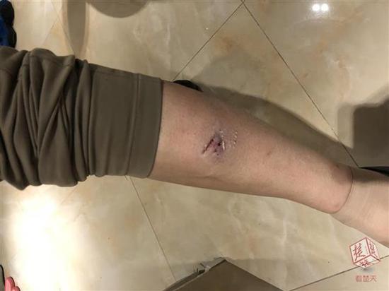 武汉一流浪狗连续咬伤十多人 警方将采取行动(图2)