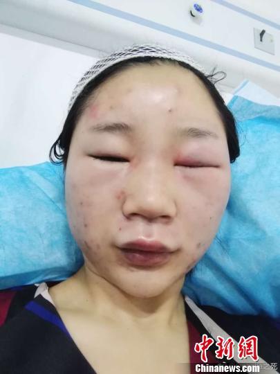 图为当事人提供的伤情图。 网络图